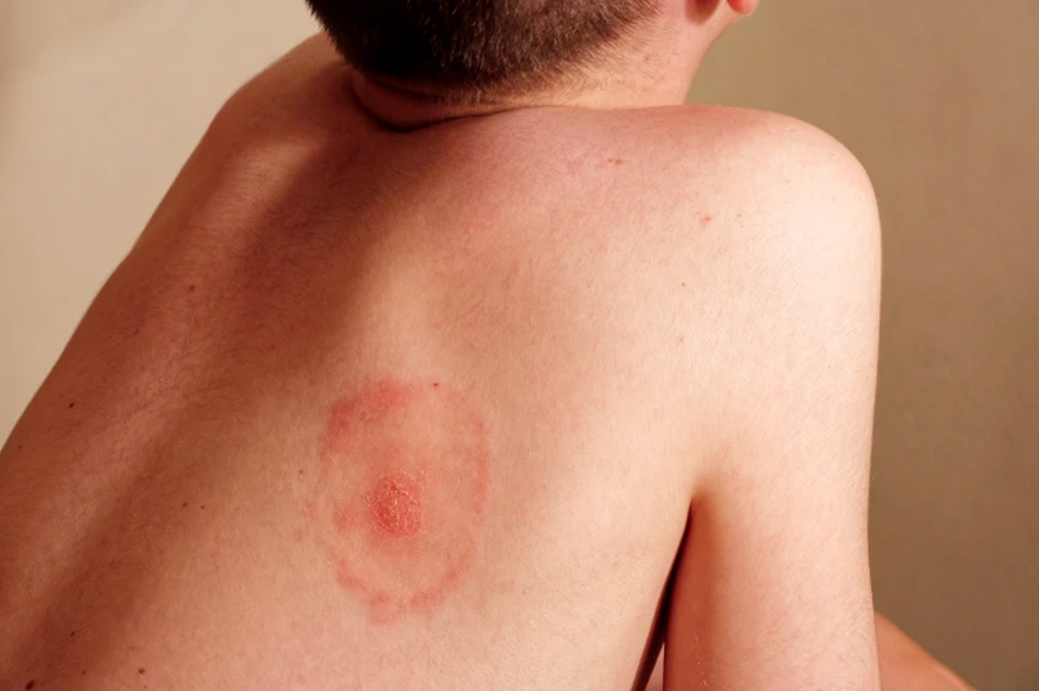 What are the of causes hives? | What are the symptoms of hives? | How long do hives last? | When to seek medical treatment for hives? | How are the hives treated and cured? | Various pictures of hives | diseases that cause hives in adults male and female | what are the Causes of hives in female adults | Can hives be a sign of something serious diseases |Various treatment of hives | How to cure hives fast and quick | Pictures of hives rash on legs and hand